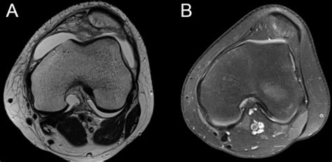 Axial cut magnetic resonance images of a normal trochlea (A) and... | Download Scientific Diagram