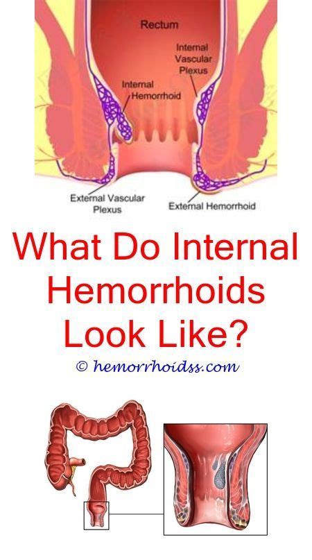 Will Clotted Hemorrhoids Go Away Are Internal Or External Hemorrhoids More Commonhow Do U Kno