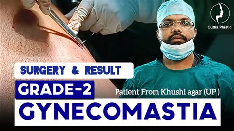 Gynecomastia Surgery And Result Khusingar Deoria Gorakhpur Prayagraj Azamgarh Mau Ghazipur