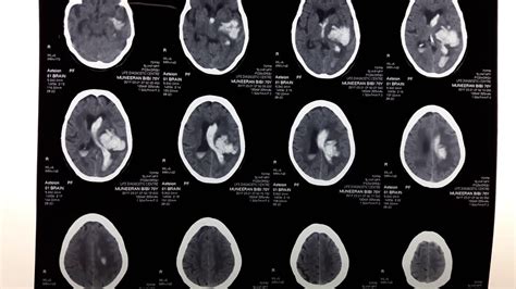 Hemorrhagic Stroke Ct Scan Interpretation Ct Scan Machine Images