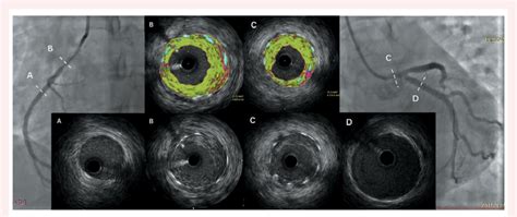 Virtual Histology Intravascular Ultrasound Showing A Rapid Within 2