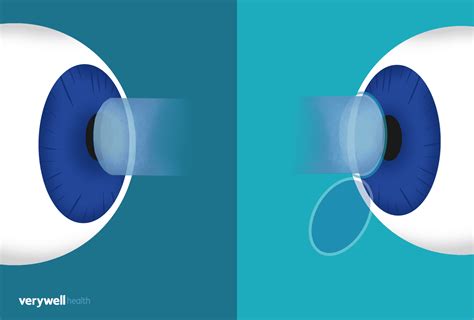 PRK vs. LASIK: A Presurgical Planning Guide