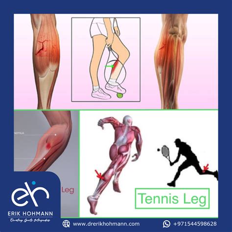 Tennis Leg - Dr. Erik Hohmann