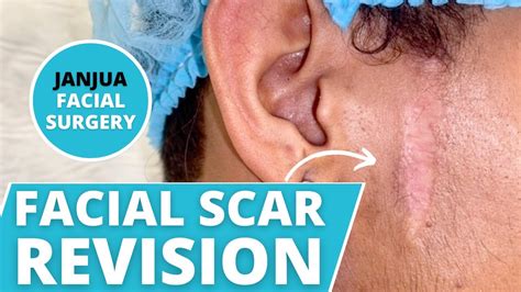 Facial Scar Revision On Cheek Gblc Dr Tanveer Janjua New Jersey