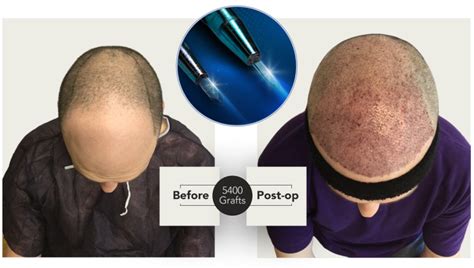 Sapphire Fue Hair Transplant Regal Clinic