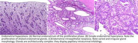 Carcinoma Of The Endometrium Flashcards Quizlet