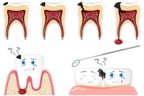 Conoce Los Tipos De Caries Dentales Pyp Clinic