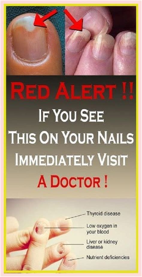 Red Alert If You See This On Your Nails Immediately Visit A Doctor