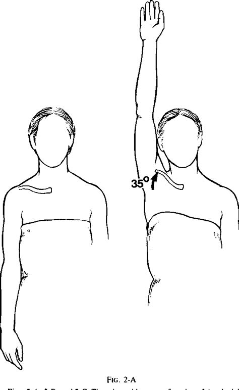 Figure From Spontaneous Atraumatic Anterior Subluxation Of The