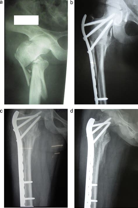 Biological Fixation Of Comminuted Subtrochanteric Fractures With