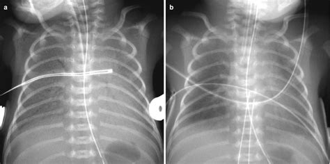 Neonatal Chest Imaging Radiology Key