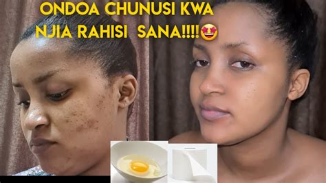 Kuondoa Chunusi Usoni Na Mabaka Kwanjiarahisi How To Get Rid Of Acne