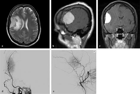 19 Meningioma Embolization Neupsy Key