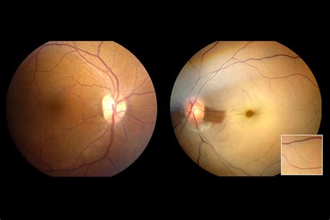 Management of Central Retinal Artery Occlusion - Professional Heart ...