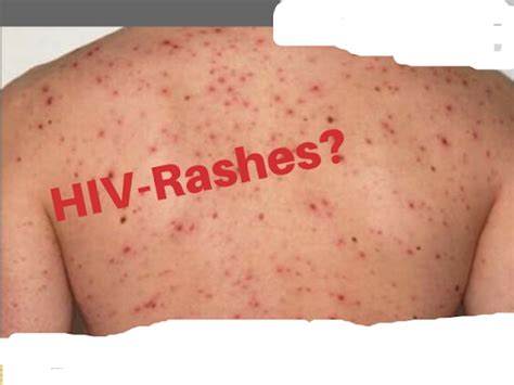 Hiv Symptoms Rash Infoupdate Org