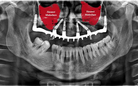 Impianti Dentali Pterigoidei Una Soluzione Innovativa Per La Perdita