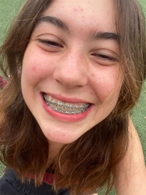 Pin By Shrood Burgos On Braces Braces Girls Dental Braces Getting Braces