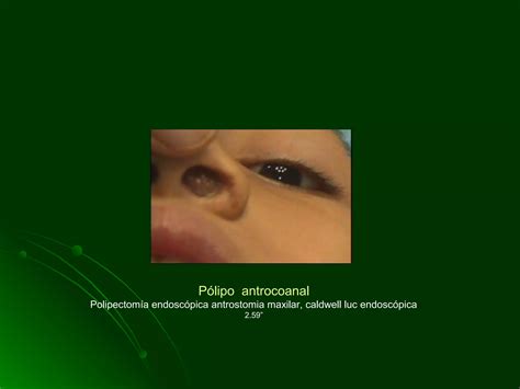 Cirugia Endoscopica En Poliposis Nasal Ppt