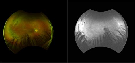 California Peripheral Retinal Holes With Lattice Degeneration RG AF