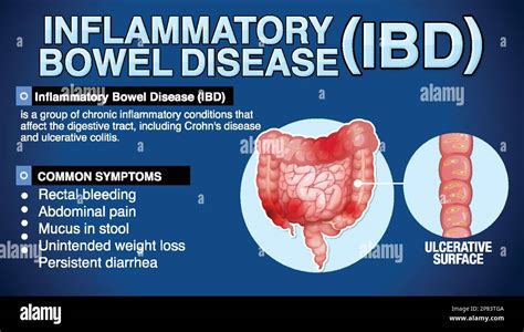 Inflammatory Bowel Disease Ibd Infographic Illustration Stock Vector