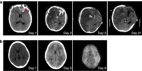 Analysis Of Human Cerebral Oedema Progression A Serial Axial