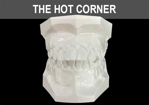 The Hot Corner Paradigm Dental Models