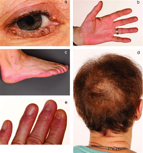 Clinical Findings Eyelids With Multiple Hidrocystomas A Moderate