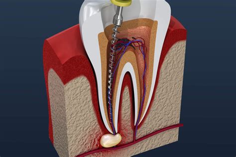 Root Canal Treatment Process 3d Illustration Hancock Village Dental Dentist Clermont Florida