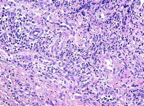 Tumoral Stroma Infiltrated With Lymphocyte Inflammatory Cells