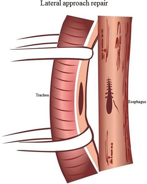 Conceptual Illustration Of Lateral Approach Repair Showing Separation