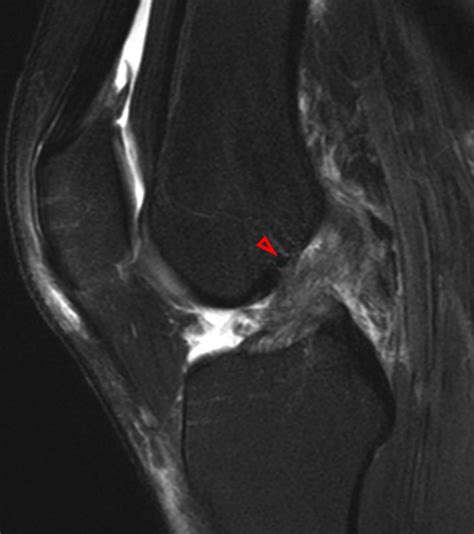 Medial Supporting Structures Of The Knee With Emphasis On The Medial