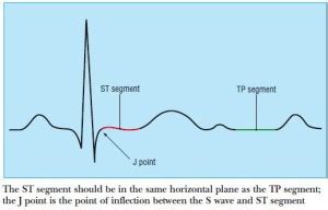 Electrocardiogram Guide Ekg Ecg Stepwards