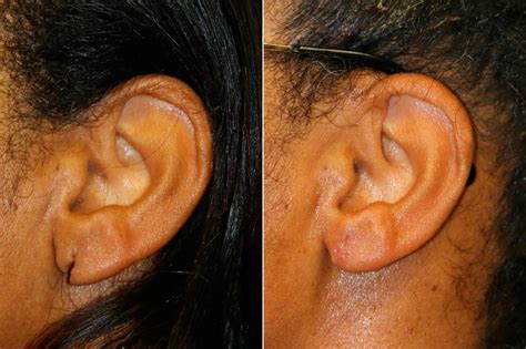 Ear Lobe Repair Photos Chevy Chase Md Patient 14583