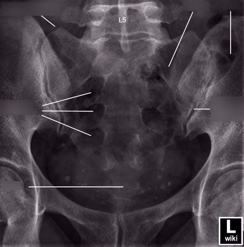 Radr 1411 Ap Axial Sacrum X Ray Anatomy Diagram Quizlet