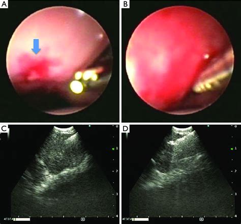 Endobronchial View And Ultrasound View A Endobronchial View With