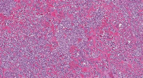 Myoepithelial Carcinoma Of The Salivary Glands Ottawa Atlas Of Pathology