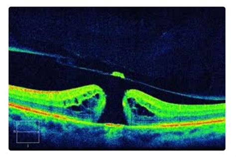 Macular Hole Stages| Southern Vitreoretinal Associates