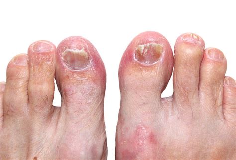 Imágenes De Tinea Pedis Fotos E Imágenes De Stock De Tinea Pedis