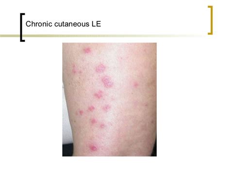 Cutaneous Lupus Lesions