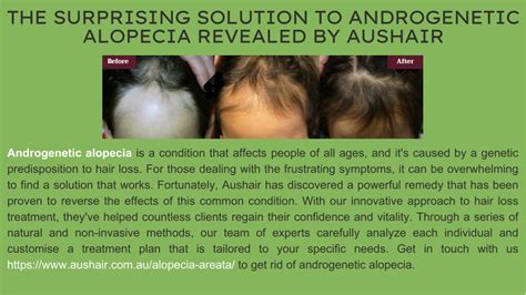 Ppt The Surprising Solution To Androgenetic Alopecia Revealed By