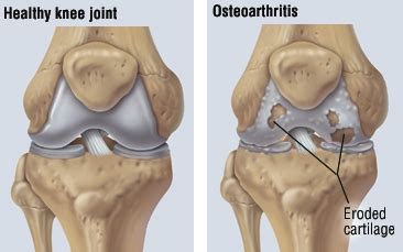 Regenerative Therapies For Osteoarthritis Dr Michael A Castillo Md