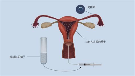 试管婴儿技术新闻中心柬埔寨试管婴儿 柬埔寨生殖医院 第三代试管婴儿 丹诺国际生殖医院