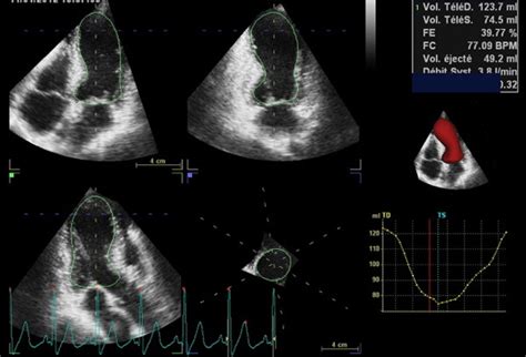 Standard And Advanced Echocardiography In Takotsubo Stress