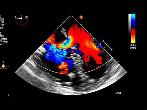 Atrial Septal Defect Transesophageal Echocardiogram