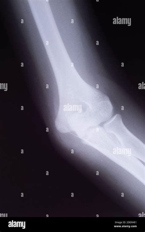 Humerus Fracture X Ray Hi Res Stock Photography And Images Alamy