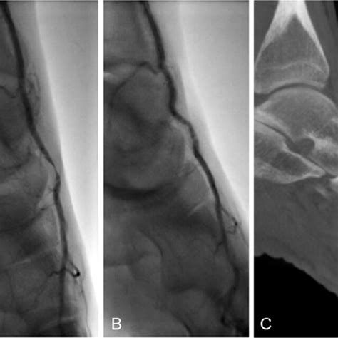 Dynamic Fluoroscopic Angiography Imaging Depicting Dpa Compression In