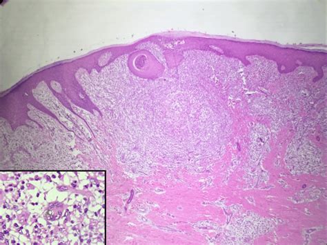 Histologic examination (x100): epidermis with moderate irregular ...