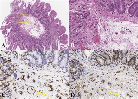 Photomicrographs Of The Duodenal Tissue Obtained By Endoscopic Biopsy