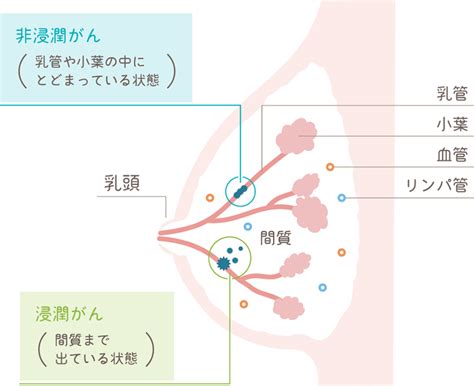 乳がん｜下北沢駅｜乳腺外科・甲状腺外来｜下北沢乳腺・甲状腺いしがきクリニック