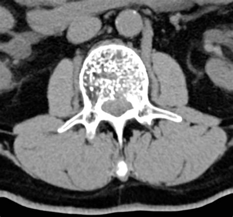 Aggressive Spinal Hemangioma Image